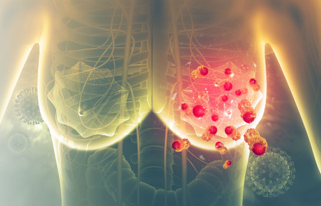 Illustration of breast cancer cells