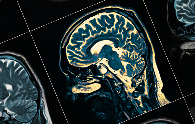 MRI Scan. Credit:iStock.com