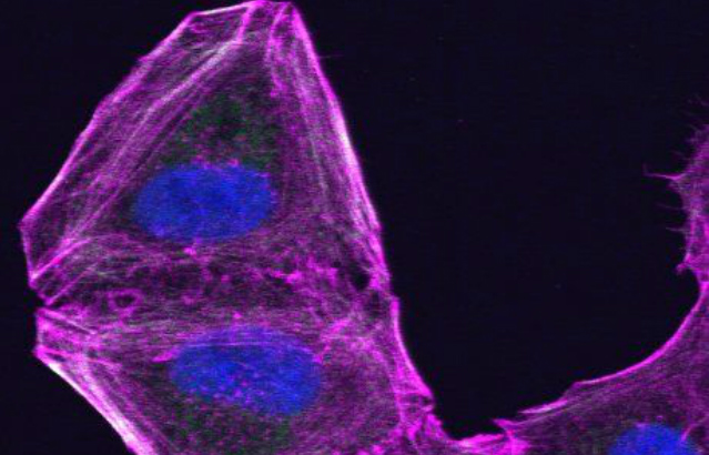 A drug resistant melanoma cell that has altered its cytoskeleton