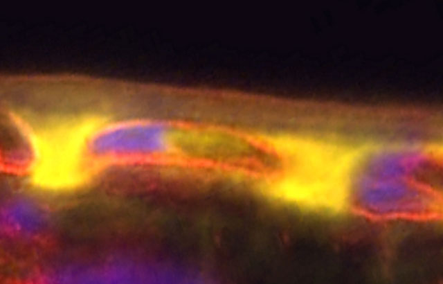 Accumulation of FHR-4 protein (yellow) within the macula