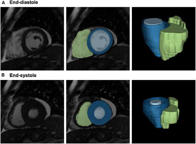 Radiomics analysis of cardiac MRI scans