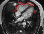 Heart MRI scan showing the area of fat detected by the AI tool