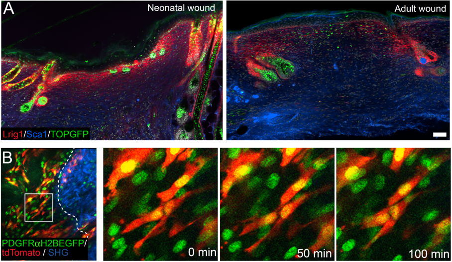 Figure 2: Fibroblast subpopulations during wound healing. (A) Exploring why skin regeneration ability decreases with age. There is a strong Wnt/β-catenin signalling activation (TOPGFP, green) in adult wound beds and placodes of regenerating hair follicles in neonatal wounds. In addition neonatal wounds show higher abundance of papillary fibroblasts (Lrig1, red) compared to reticular fibroblasts (Sca1, blue), which has strong implications for tissue regeneration. (B) In vivo live imaging of dermal fibroblast subpopulations during wound healing revealed how fibroblasts (nuclei, green; cytoplasm, red) polarise and migrate towards the wound bed centre in the early tissue repair phase. 