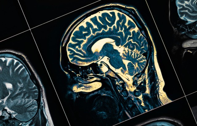 A picture of a brain scan, showing the head in profile